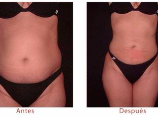 Antes y despues de lipoescultura