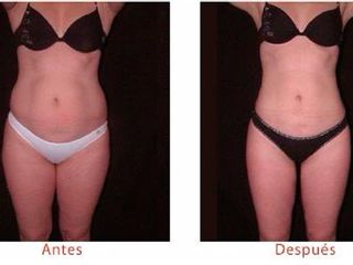 Antes y despues de lipoescultura