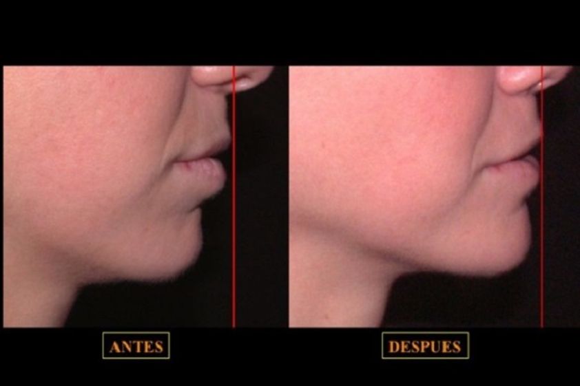 Mentoplastia antes y después - 597897