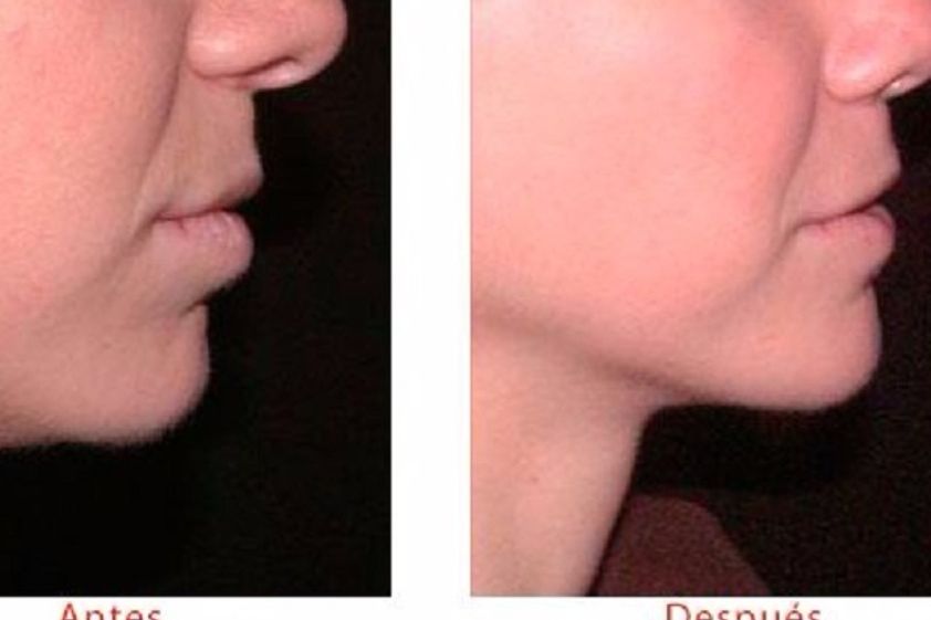 Mentoplastia antes y después - 597898