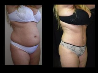 Antes y despues de Mini-Dermolipectomía y Dermolipectomia clásica