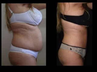 Antes y despues de Mini-Dermolipectomía y Dermolipectomia clásica