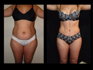 Antes y despues de Mini-Dermolipectomía y Dermolipectomia clásica
