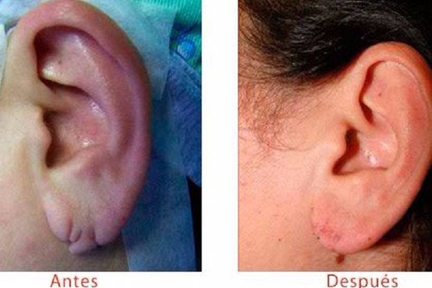 Eliminar cicatrices antes y después - 600316