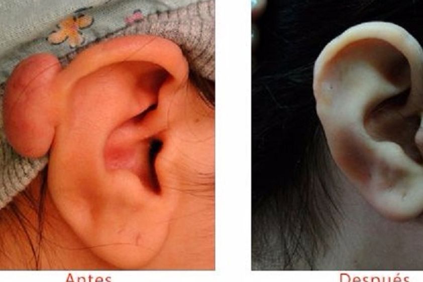 Eliminar cicatrices antes y después - 600317