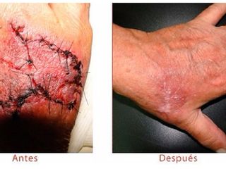 Antes y despues de tratamiento de cicatrices