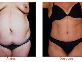 Antes y despues de tratamiento a Hernias y eventraciones