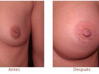 Antes y despues de reconstruccion mamaria