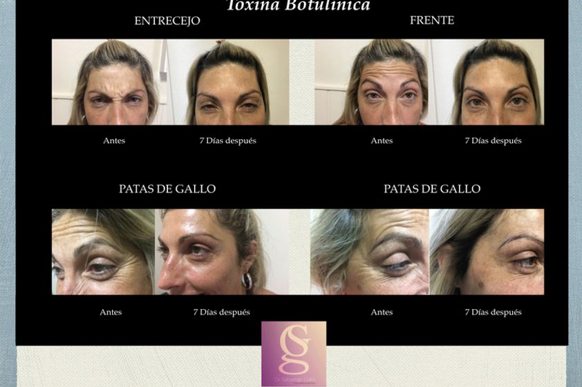 Botox antes y después - 632132