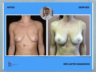 implantes mamarios