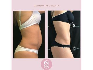 Antes y después Dermolipectomia 1 - Dr.Gallo