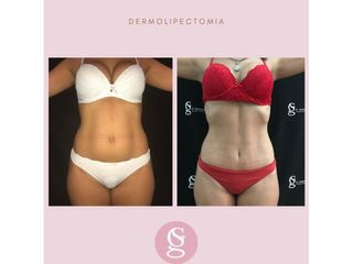 Antes y después Dermolipectomia  - Dr.Gallo