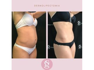 Antes y después Dermolipectomia - Dr.Gallo