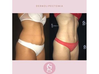 Antes y después Dermolipectomia - Dr.Gallo