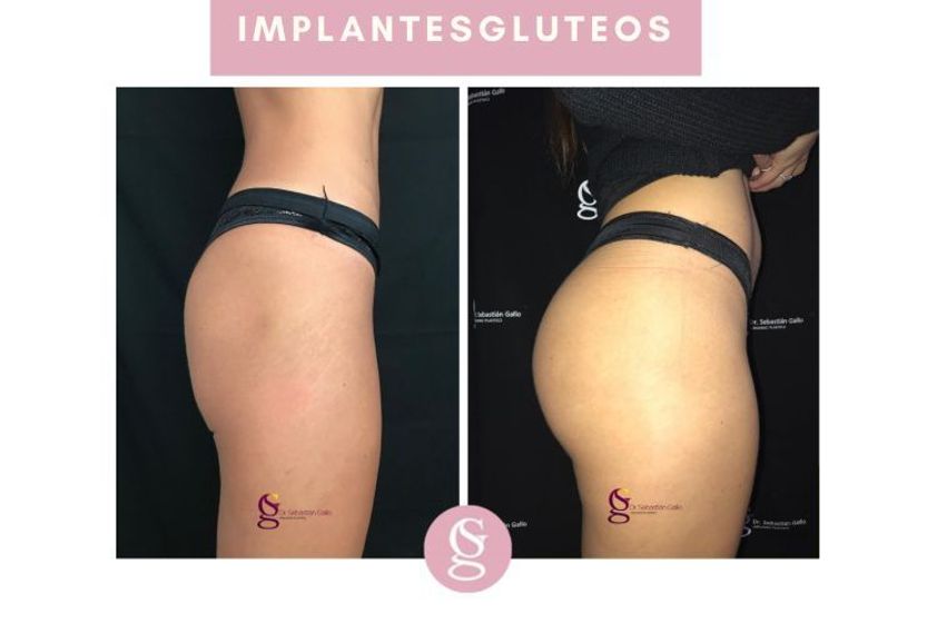 Aumento glúteos antes y después - 688179