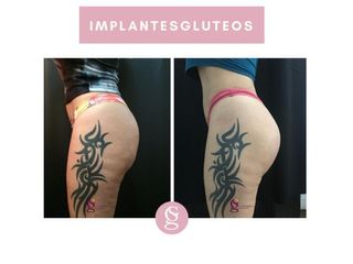 Aumento glúteos - Dr. Sebastián Gallo