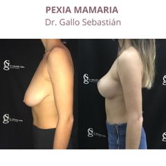 Mastopexia - Dr. Sebastián Gallo