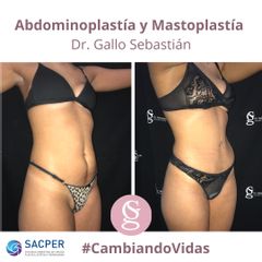 Abdominoplastia - Dr. Sebastián Gallo