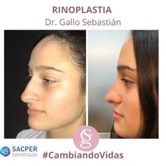 Rinoplastia - Dr. Sebastián Gallo