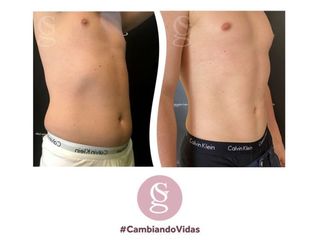 Liposucción Hombre - Dr.Sebastian Gallo