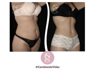 Dermo-Lipo-Abdominoplastia - Dr.Sebastian Gallo