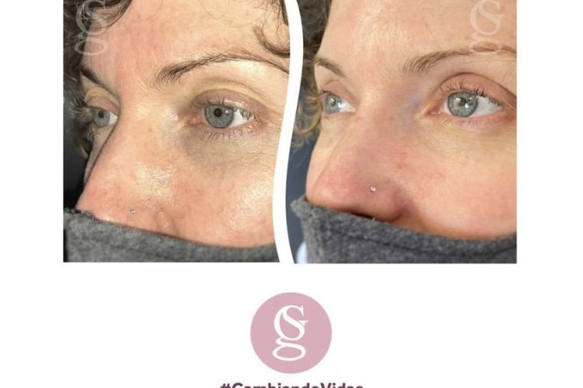 Blefaroplastia antes y después - 794723