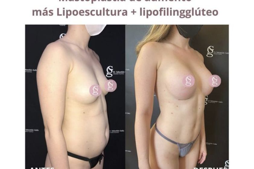 Mastopexia antes y después - 794727