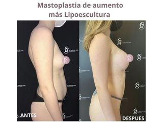 Mastoplastia de Aumento más Lipoescultura