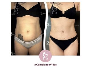 Dermo-lipo- Abdominoplastia - Dr. Sebastian Gallo