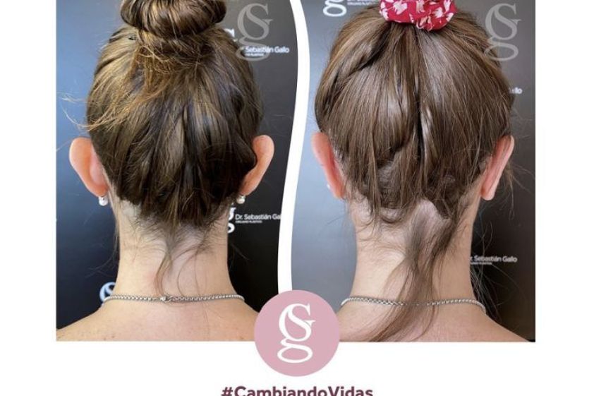 Otoplastia antes y después - 794733