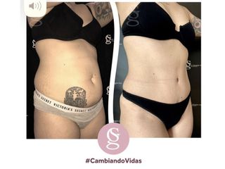 Dermo- Lipo-Abdominoplastia - Dr. Sebastián Gallo