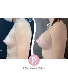 Aumento mamas - Dr. Sebastián Gallo