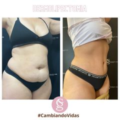 Abdominoplastia - Dr. Sebastián Gallo
