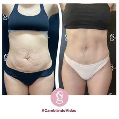 Abdominoplastia - Dr. Sebastián Gallo