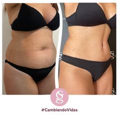 Abdominoplastia - Dr. Sebastián Gallo