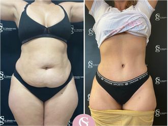 Abdominoplastía antes y después - 853594