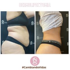 Abdominoplastia - Dr. Sebastián Gallo