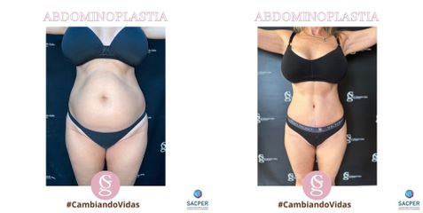 Abdominoplastia - Dr. Sebastián Gallo