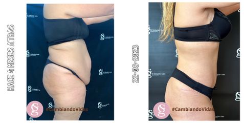 Abdominoplastia - Dr. Sebastián Gallo
