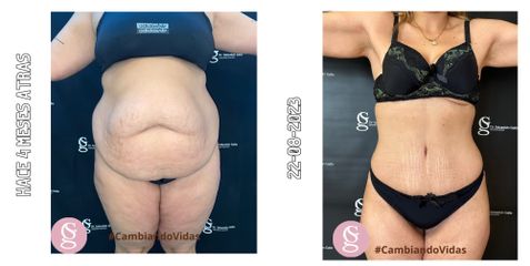 Abdominoplastia - Dr. Sebastián Gallo