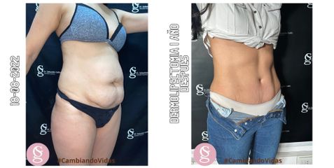 Abdominoplastia - Dr. Sebastián Gallo