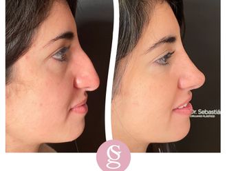 Rinoplastia antes y después - 853608