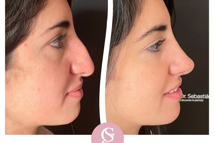 Rinoplastia antes y después - 853608