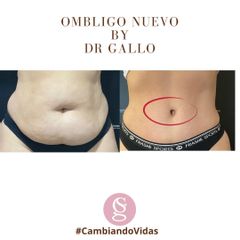 Abdominoplastia - Dr. Sebastián Gallo