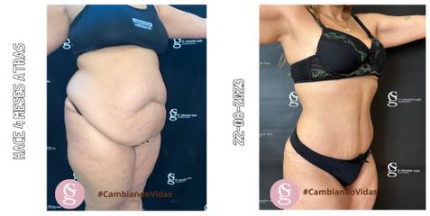 Abdominoplastia - Dr. Sebastián Gallo