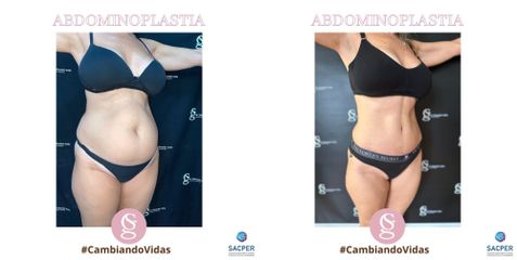 Abdominoplastia - Dr. Sebastián Gallo