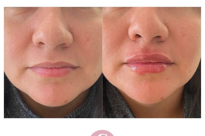 Relleno de labios antes y después - 853614