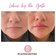 Relleno de labios - Dr. Sebastián Gallo