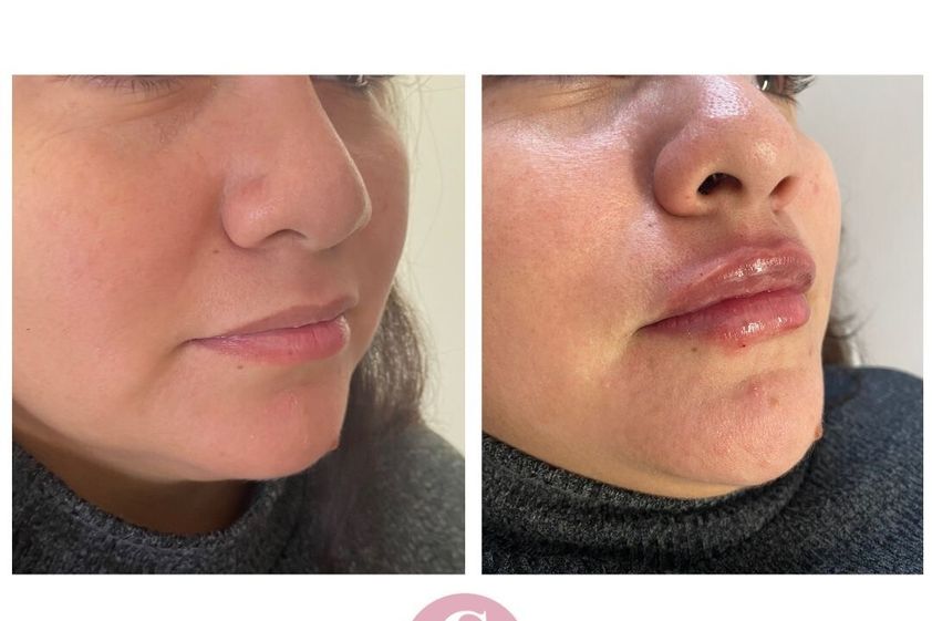 Relleno de labios antes y después - 853615