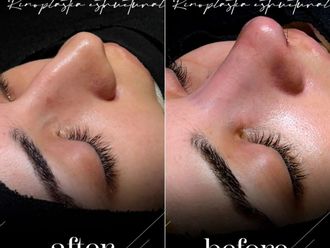 Rinoplastia antes y después - 881411